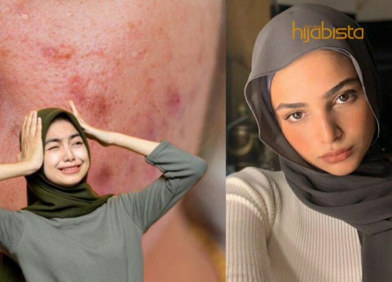 Adakah Anda Mahukan Kulit Bebas Jerawat? Hadkan Pengambilan 4 Perkara Ini!