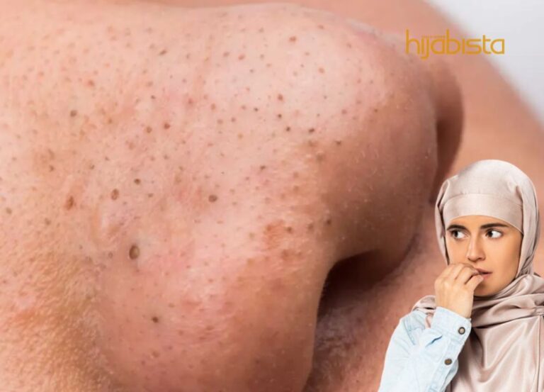Cara Mudah Mengatasi ‘Blackhead’ Yang Degil Dan Banyak, Mudah Sahaja!