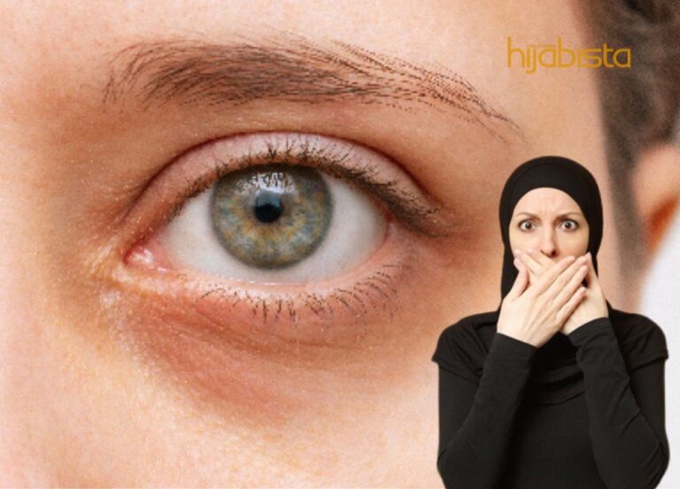 Ia Bukan Cuma Kurang Tidur, Ini Antara Punca Kemunculan Mata Panda!