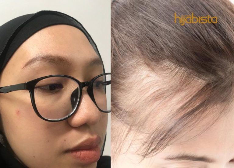 Rambut Botak Di Bahagian Dahi, Hijabi Selesaikan Masalah Ini Dengan Cara Semulajadi. Tiada Lagi Tekanan!