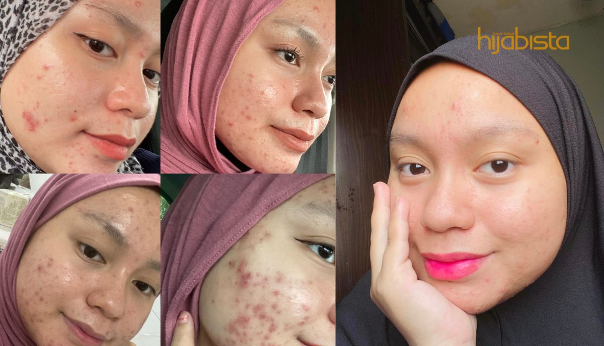 Tak Paksa, Tapi Syorkan! Hijabi Ini Kongsi Perjalanan Rawat Muka Breakout Teruk, Perlu Percaya Dengan Proses..