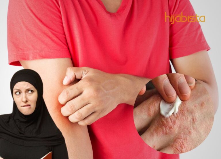 Penghidap Ekzema, Perlu Waspada Pilih Produk!