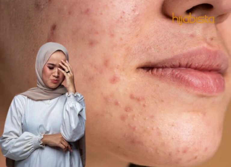 Mengapa Bekas Jerawat Susah Hilang? Ini Alasannya.