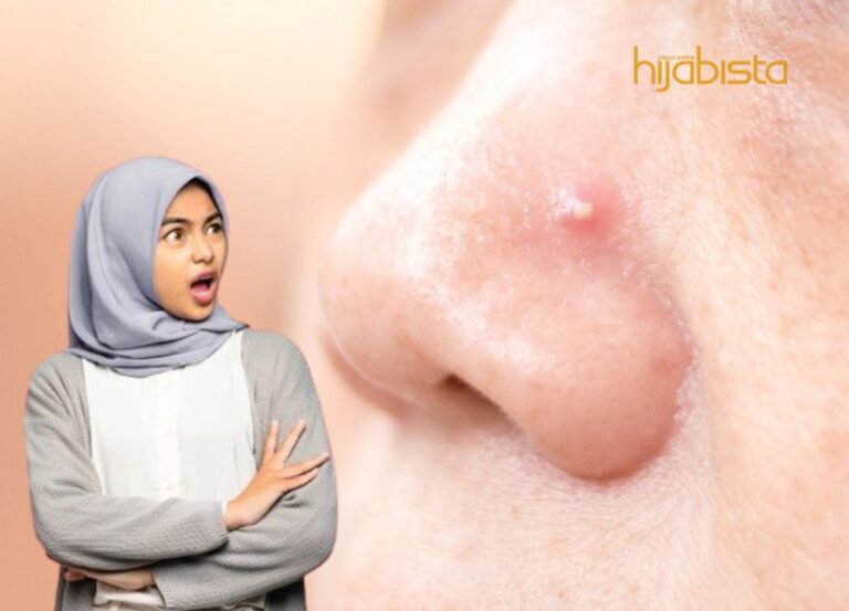 Jerawat Di Hidung Menganggu? Cuba Atasi Dengan Cara Ini!
