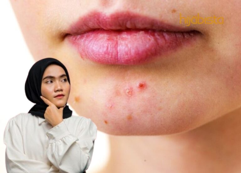 Jerawat Di Dagu? Ketahui Cara Mengatasinya!