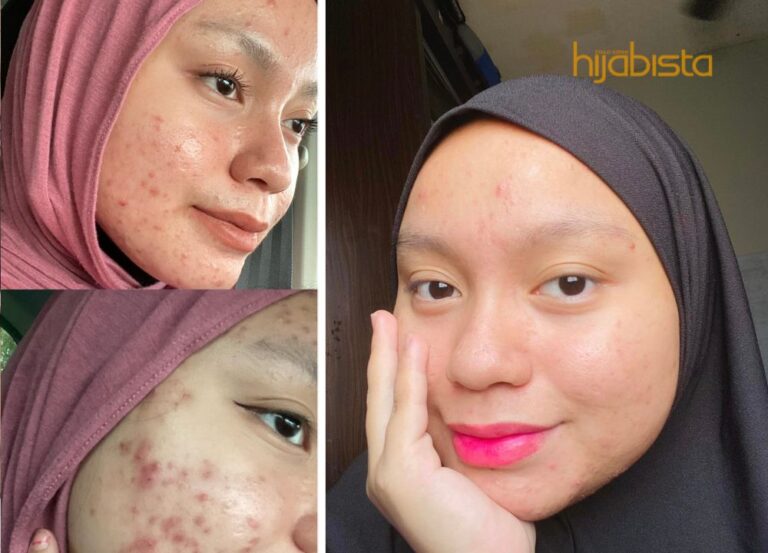 Percaya Pada Proses! Hijabi Ini Kongsi Perjalanan Rawat Muka Breakout Teruk
