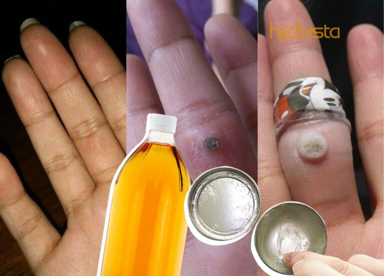 Hilangkan Ketuat Dengan Cara Mudah, Guna Cuka Epal & Vaseline Sahaja!