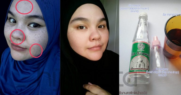 Hanya Bermodalkan Tak Sampai RM10, Diy Toner Ini Boleh Lenyapkan Terus Jerawat & Kesan Jeragat Degil
