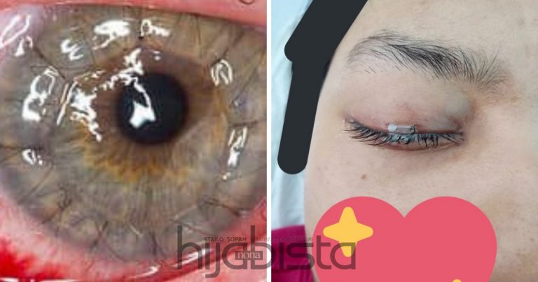 Akibat Kanta Lekap, Mata Terpaksa Dibedah Kerana Terkena Jangkitan Teruk Hingga Bernanah