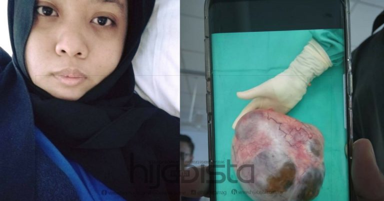 Belum Kahwin Tapi Macam Hamil 7 Bulan Sebab Bawa ‘Cyst’ Seberat 5 Kg, Gadis Ini Syukur Bukan Tanda Kanser