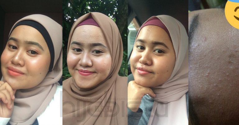 ‘Breakout’ Sebabkan Kulit Gadis Ini Jadi Gatal Hingga Garu Kepala Di Dinding, Akhirnya Pulih Dengan 1 Produk
