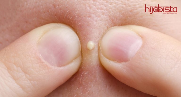 Ketahui Jenis Jerawat Yang Menjadi Tetamu Tanpa Diundang Sebelum Merawatnya. No 4 Paling Ditakuti Hijabis