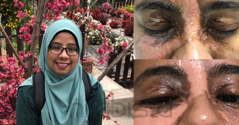 Wanita Ini Alami Melecur Teruk Di Wajah & Leher Hingga Sebabkan Kecacatan Lepas Guna Khidmat Spa Bergerak