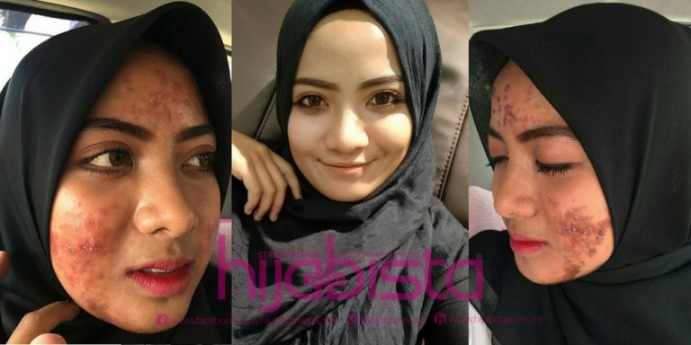 Hanya Dengan Modal RM300, Wajah Gadis Ini Akhirnya Pulih Daripada ‘Breakout Yang Teruk