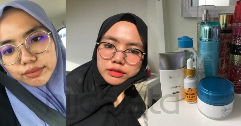 Setahun Bertahan Sebab Breakout, Akhirnya Gadis Ini Jumpa Produk Sesuai Untuk Penjagaan Wajah