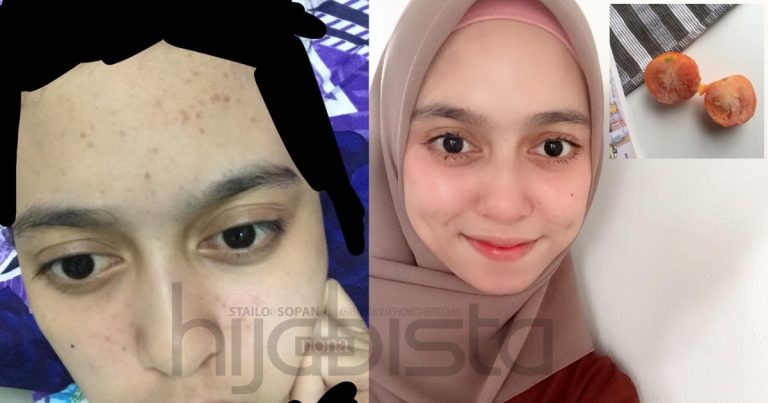 Lepas 2 Bulan Guna Tomato Sejuk Beku, Terus Wajah Gadis Ini Jadi ‘Pinkish’ & Parut Jerawat Turut Lenyap