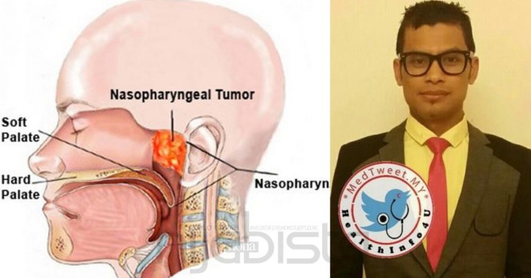 Doktor Ini Jelaskan Bahaya Ambil Makanan Yang Diawet & Ikan Kering, Salah Satu Penyebab Kanser Hidung