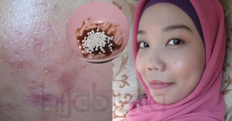 Hanya Guna Campuran Asam Jawa & Bedak Sejuk, Parut Jerawat Wanita Ini Hilang Dalam Masa Seminggu. WOW!