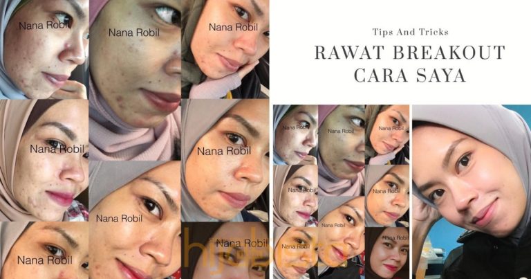 Dapat Ribuan Share, Wanita Ini Kongsi Cara Pantas Bagi Merawat Kulit Breakout Dengan Selamat