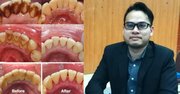 6 Mitos ‘Scaling’ Gigi Yang Takutkan Orang, Tapi Doktor Ini Jelaskan Semuanya Tidak Benar Sama Sekali