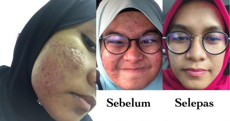 Ambil Masa 3 Tahun Untuk Pulih Dari ‘Breakout’, Gadis Ini Keluar Kos Bawah RM100 Hanya Di Hospital Kerajaan