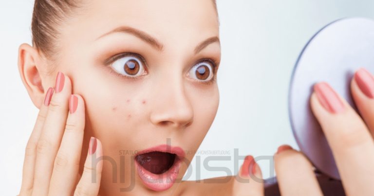 8 Cara Mudah Hilangkan Parut Jerawat Tanpa Penggunaan Bahan Kimia. Confirm Selamat!