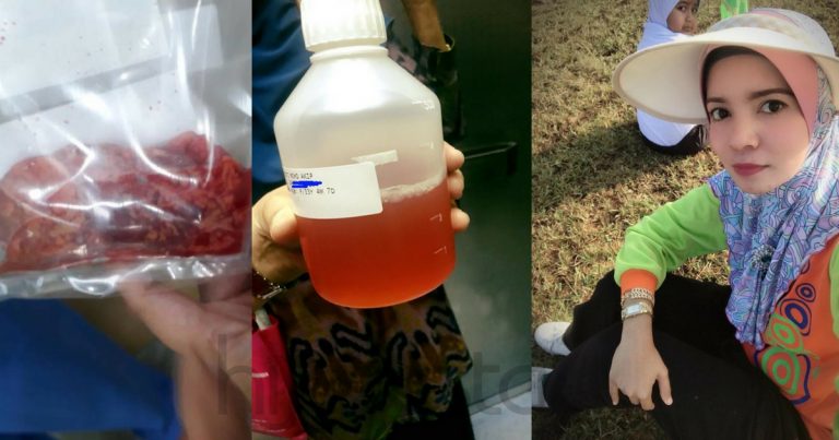 Beratnya Dugaan Wanita Ini, Dalam Masa 2 Minggu Disahkan Ovarian Cyst, Hidap Kanser & Terpaksa Buang Rahim