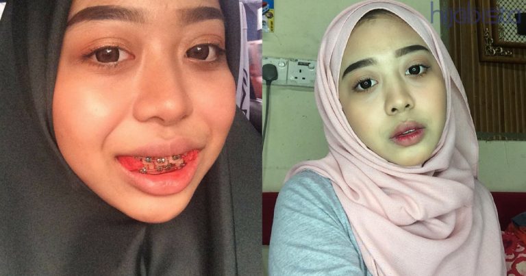 Penat DIEJEK, Gadis Ini Nekad Pakai Braces Melalui DOKTOR BERTAULIAH. Hasilnya Senyuman Jadi Cantik & Lebih CONFIDENT!