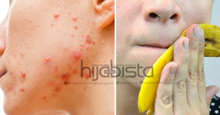 Guna Petua Tradisional, Hanya Gosok Kulit Pisang Pada Wajah Untuk Pulihkan Kulit Kusam & Parut Jerawat