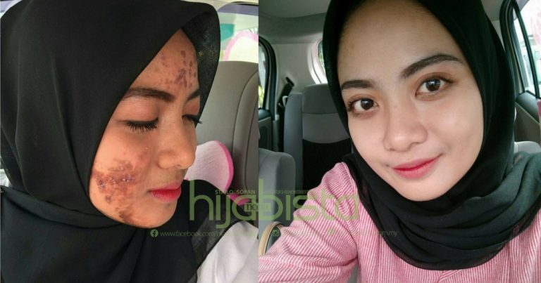 Berbekalkan RM300, Akhirnya Wajah Gadis Ini Pulih Daripada Breakout Yang Teruk