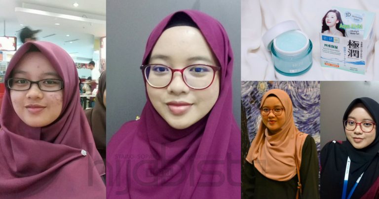 3 Tahun Derita Wajah Teruk Akibat Masalah Jerawat, Gadis Ini Akhirnya Temui Rahsia Pulih Dengan Cepat
