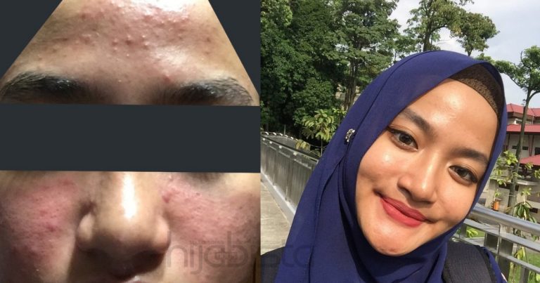 Lepas 5 Bulan Alami Breakout, Gadis Ini Ambil Masa 2 Minggu Untuk Pulih. Tak Lokek Kongsi Skincare Routine!