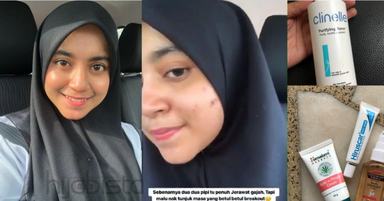 Gadis Ini Menangis, ‘Stress’ 6 Bulan Sebab ‘Breakout’ & Produk Drugstore Digunakan Untuk Lenyapkan Jerawat