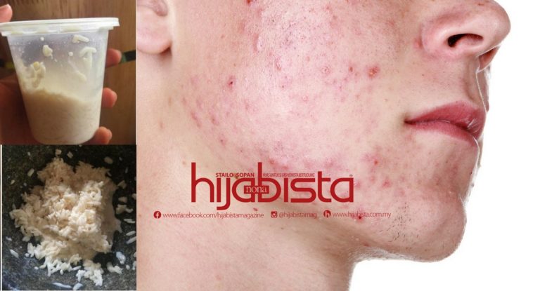 Tiada Lagi Masalah Jerawat & Kulit Berminyak Dengan Penggunaan Beras & Susu ‘Full Cream’. Mudah & Selamat!