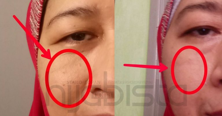 Dengan Bajet Tak Sampai RM20 Bukan Saja Dapat Kulit ‘Flawless’, Jerawat Lenyap & Blackhead Pun Hilang!