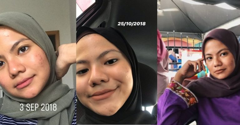 Hanya Ambil Masa Sebulan Untuk Pulihkan Wajah, Gadis Ini Kongsi Rutin Penjagaannya Dari Pagi Ke Malam