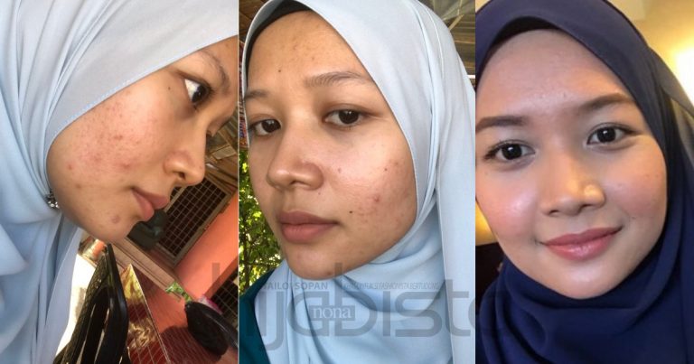 Lepas 9 Bulan Alami Masalah Kulit Akhirnya Pulih & Sihat. Wanita Ini Kongsi Rutin Penjagaan Harian Mudah!