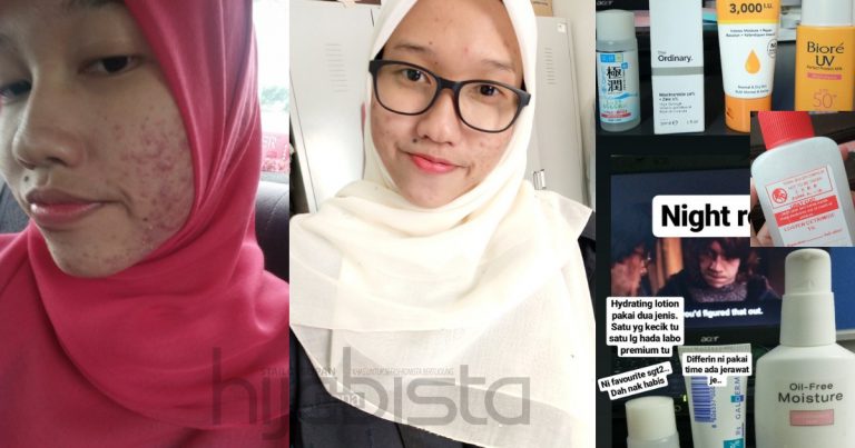 4 Bulan Wajah ‘Breakout’ Sebab Pakai Mekap, Akhirnya Pulih Lepas Guna 14 Produk Ini Termasuk Ubat Hospital