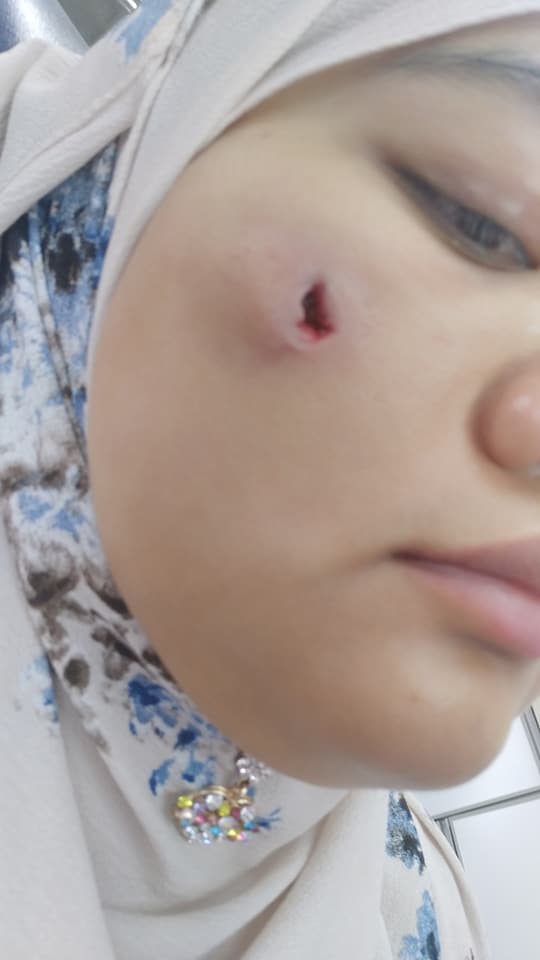 Pipi Gadis Ini Terpaksa Dibedah Lepas Muncul Ketulan