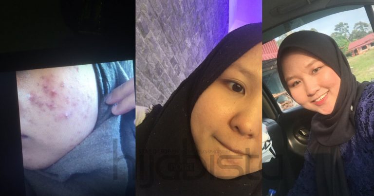 Setahun Bersabar Bila Wajah Rosak Teruk Sebab ‘Breakout’ & Akhirnya Pulih Guna Produk Bajet