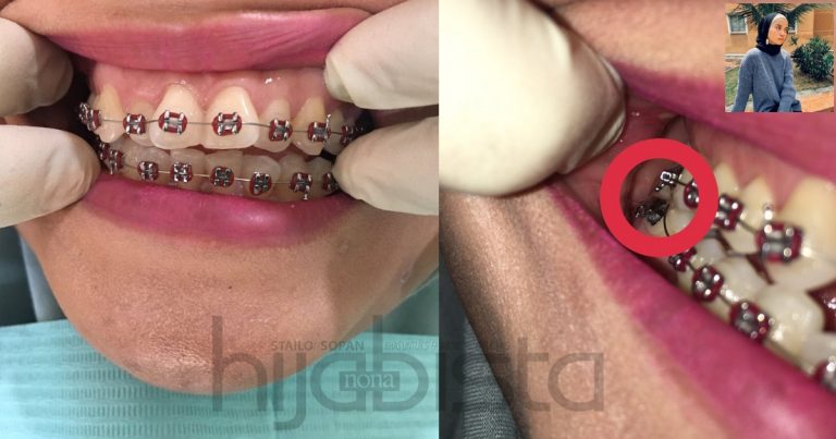 Elak Pasang ‘Fake Braces’ Dekat ‘Butik’ Kos Bawah RM1K, Sebab Kesannya Mengerikan. Pesan Gadis Ini!