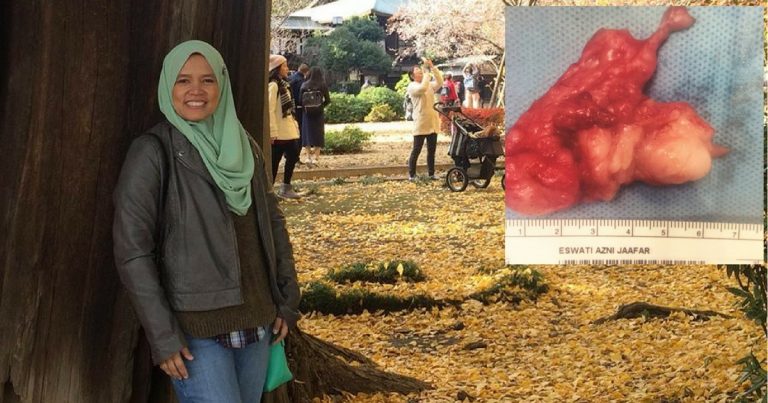 ‘Rasa Seperti Nak Mati’ – Wanita Ini Kongsi Pengalaman Buang ‘LUMP’ 7CM Ditengkuk, Takut Dikaitkan Penyakit Merbahaya