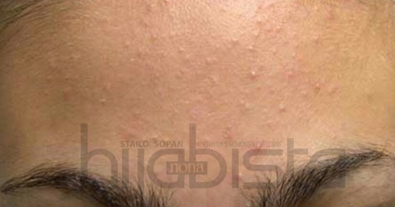 Stress Jerawat Pasir Tumbuh Di Wajah, Baca Perkongsian Lengkap Gadis Ini Cara Atasinya Dengan Mudah