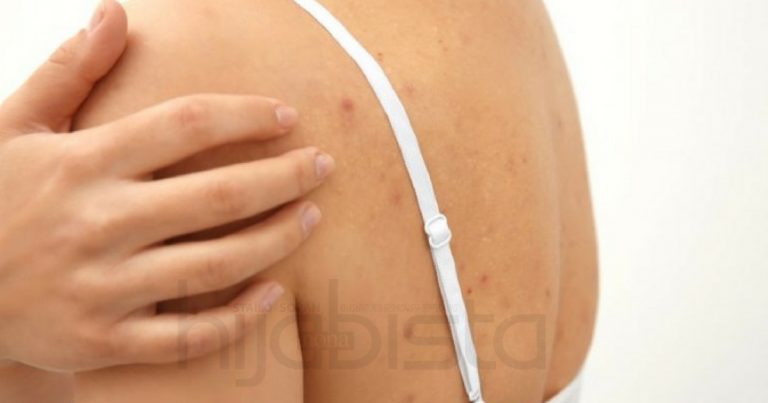 Murung Gara-Gara Masalah Jerawat Belakang Badan, 8 Tip Mudah Untuk Hijabi  Atasinya Tanpa Pening Kepala