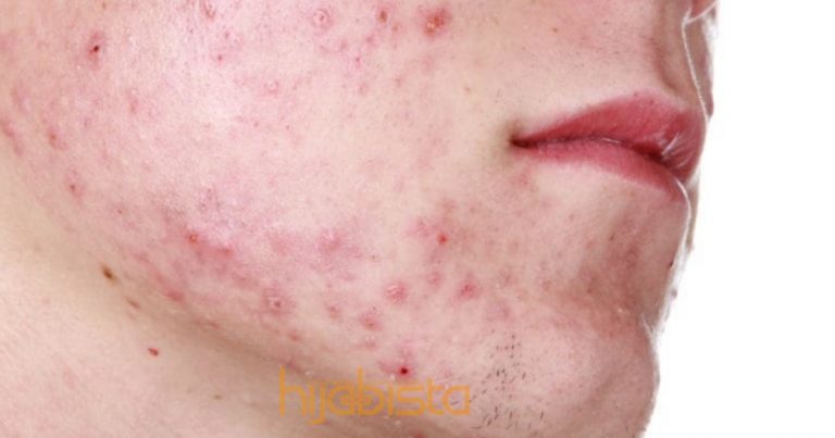 Atasi Masalah Jerawat Pasir, Pori Tersumbat Dan Tiny Bumps Dengan Langkah-Langkah Ini