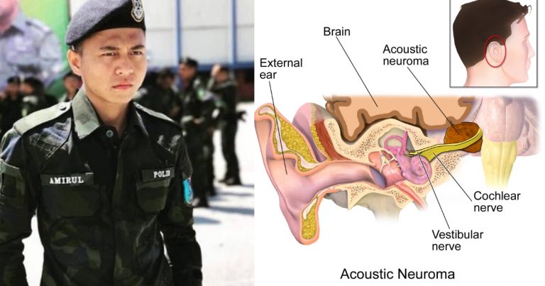 “Syukur Pada Allah Dah Bebas Dari Kanser” – Lelaki Ini Kongsi Tip Sihat Kecutkan Tumor Dalam Telinga