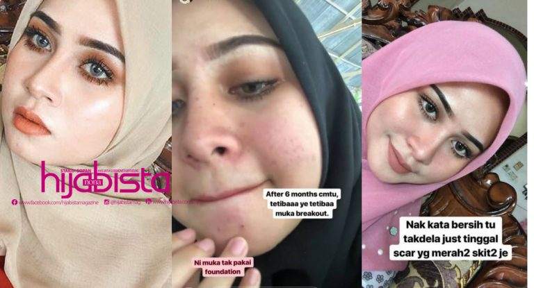 Penat Istiqomah Guna Produk Lokal, Akhirnya Ribuan Ringgit Melayang Semata-Mata Nak Hilangkan Kesan ‘Breakout’