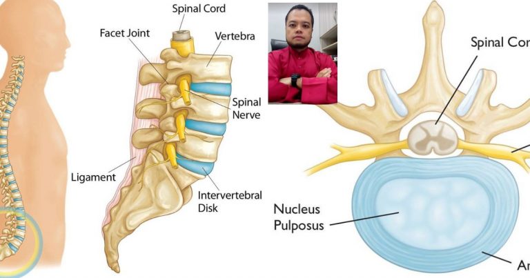 Doktor Ini Beritahu Gaya Hidup Pemalas & Obesiti Punca Usia Muda Kena Slipped Disc, Periksa 4 Lagi Sebab Lain