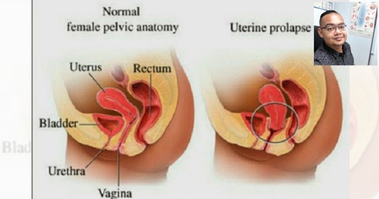 Doktor Ini Sangkal Mitos ‘Workout’ Boleh Sebabkan Peranakan Jatuh & Jelaskan 7 Punca Utamanya