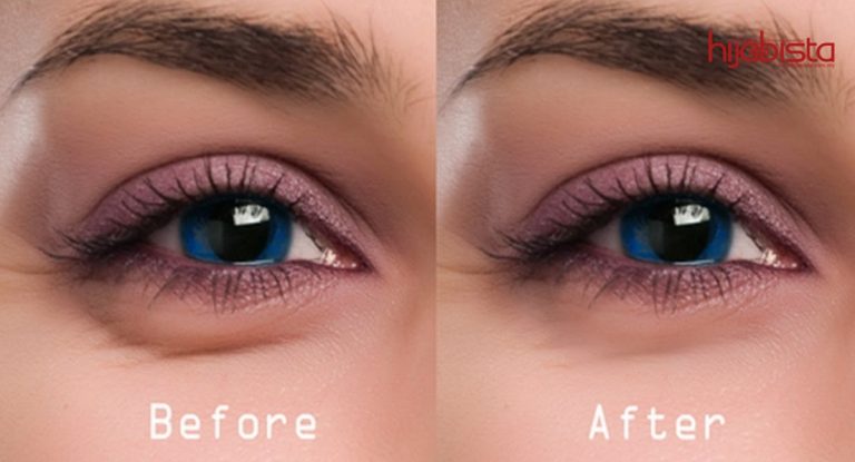 Masalah Kantong Mata Atau Eye Bag Ini 10 Cara Atasi Tanpa Pembedahan  Dan Tanpa Solekan Tebal. #10 Berkesan Sekiranya Kecemasan.